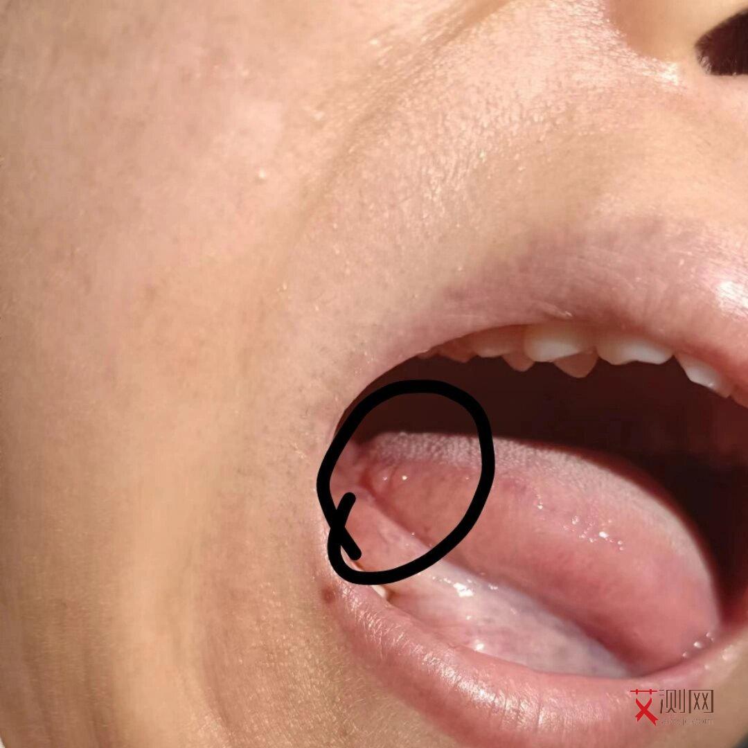 艾滋病的皮疹是什么样的图片如何判断自己得没得艾滋病