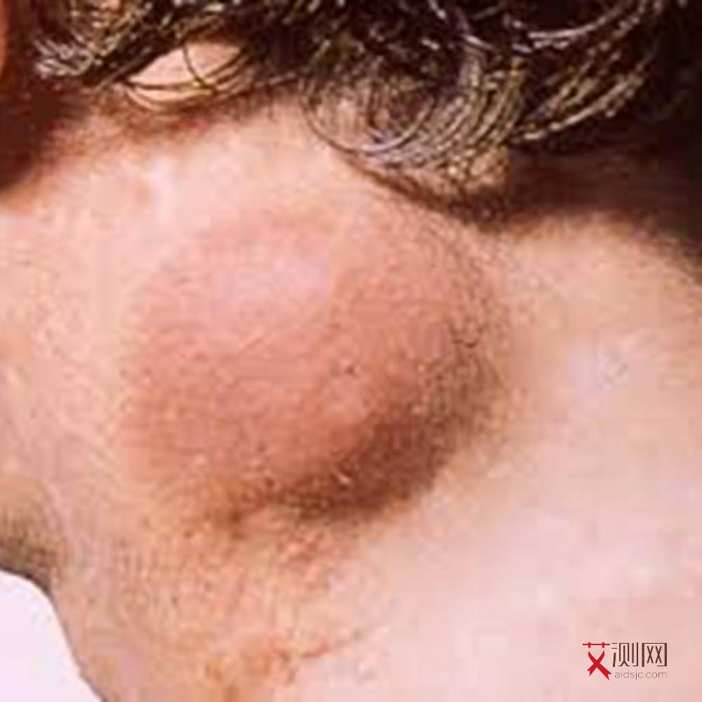 出现艾滋病会有什么症状图片女性