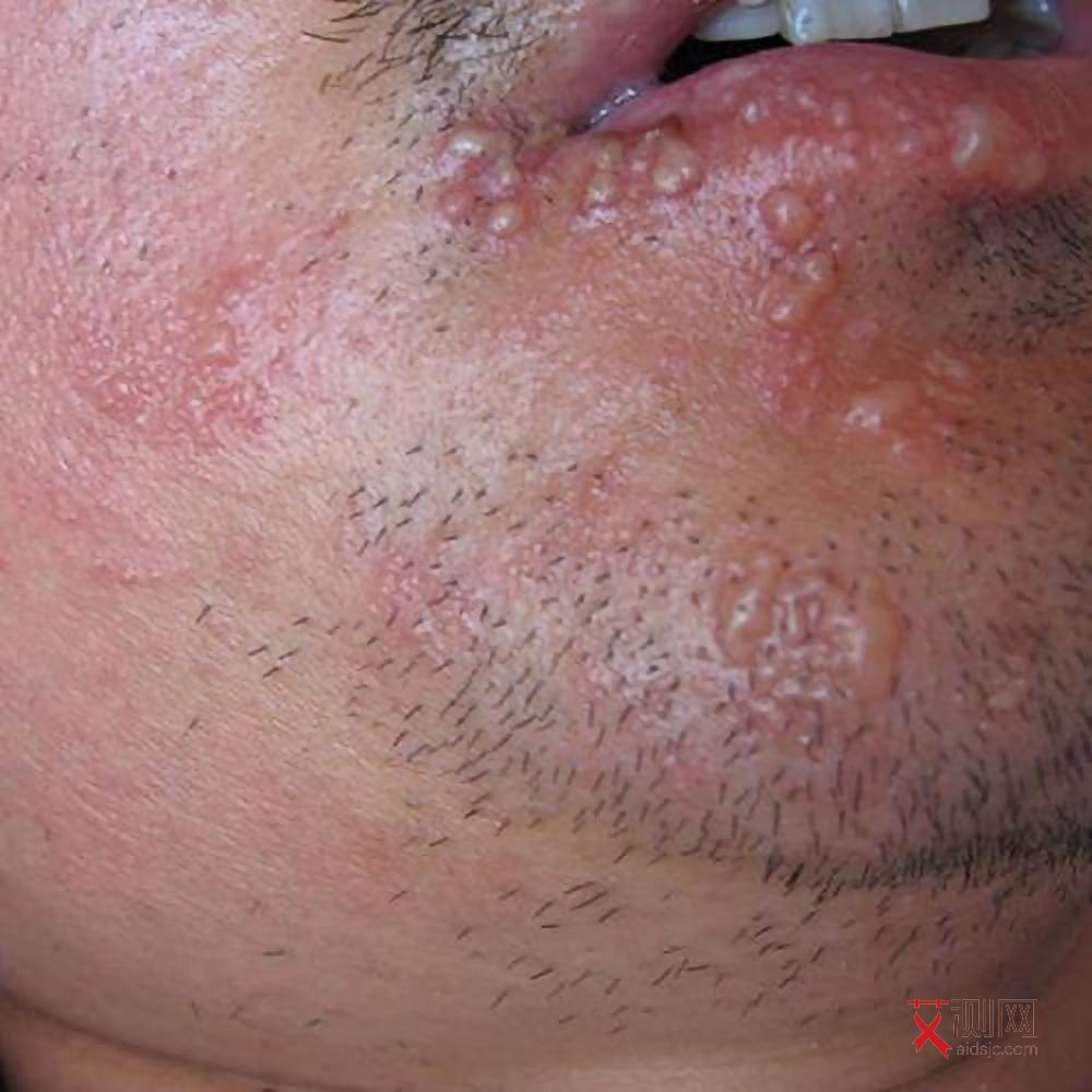 孩子感染艾滋病多久会出现症状呢图片