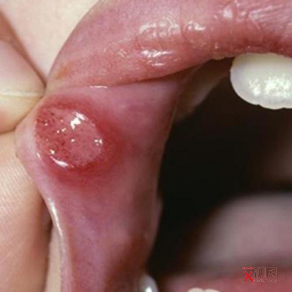 的艾滋病最明显的症状表现是什么