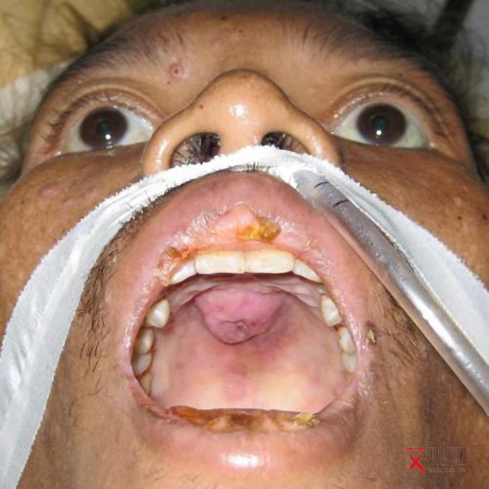 高危3个月后阴性可以排除艾滋病吗吃阻断药影响吗