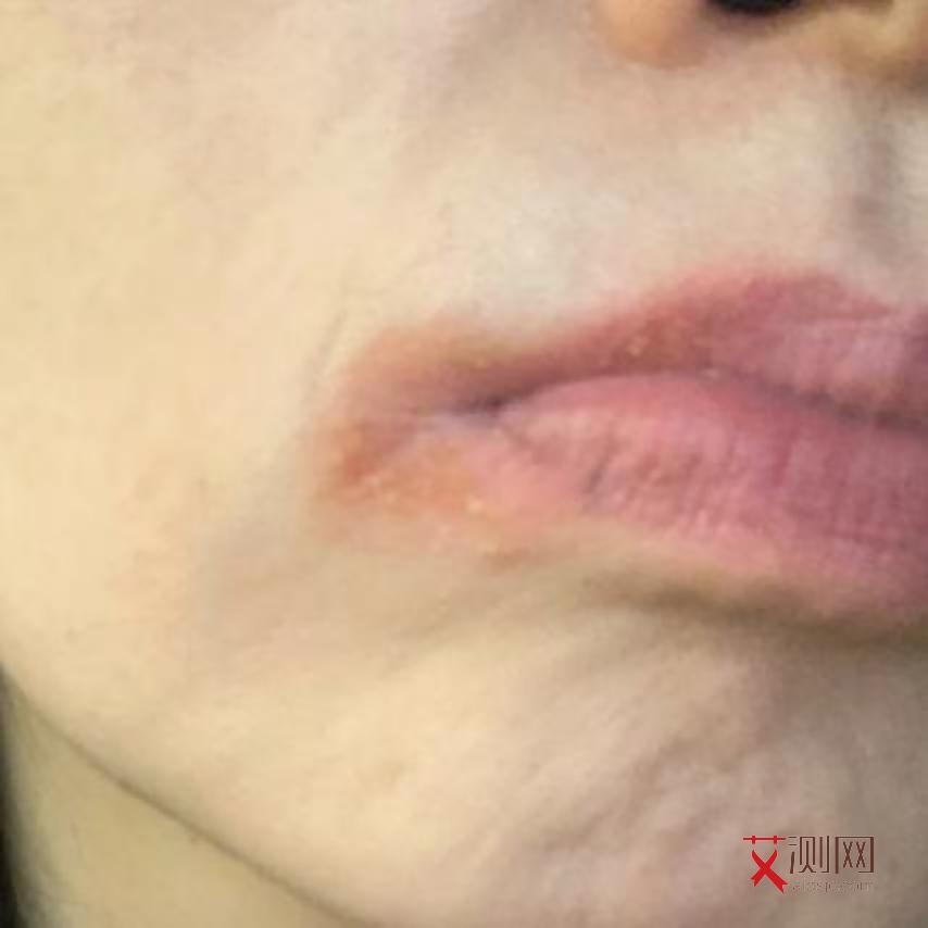 女性艾滋病前期有什么特征