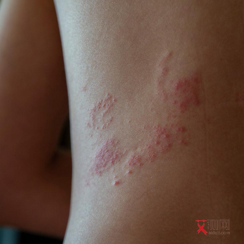 艾滋病初期有感觉吗