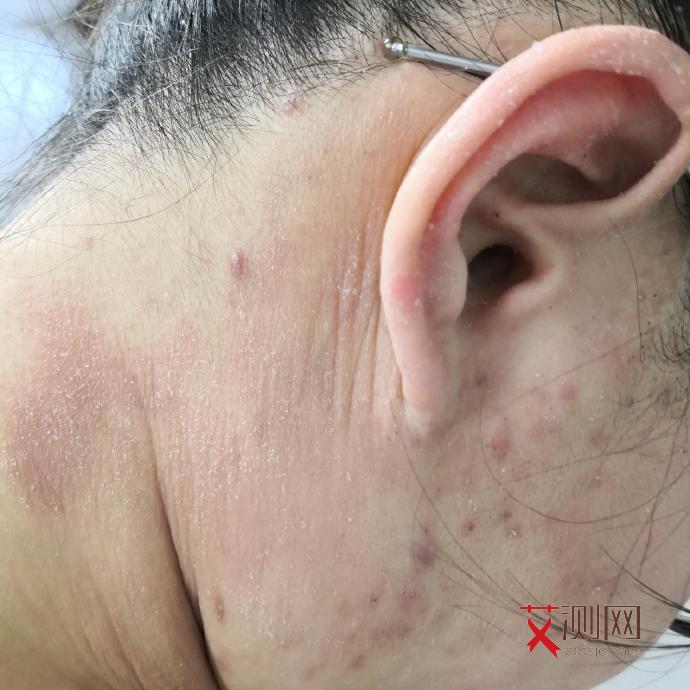 艾滋病会痒吗早期症状女性怎么办图片