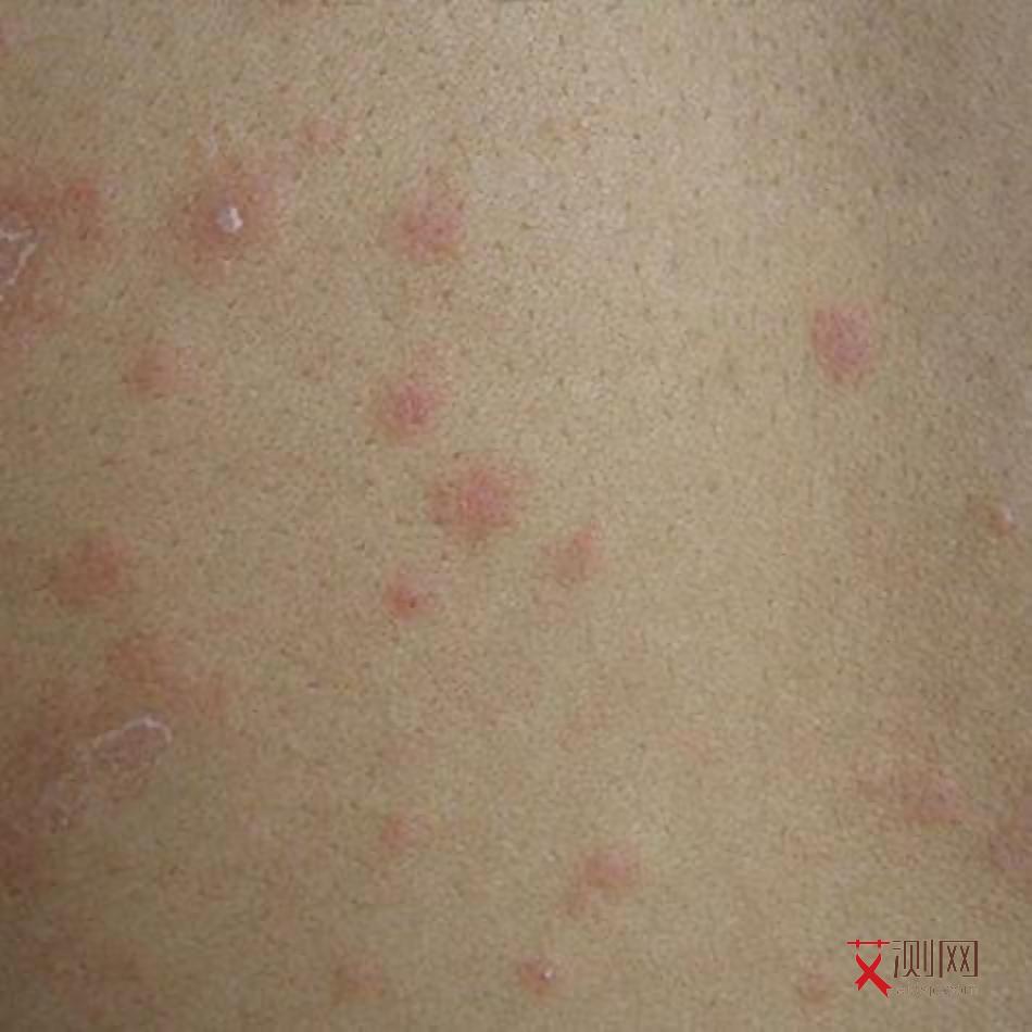 艾滋痒下面有什么症状表现吗图片女性