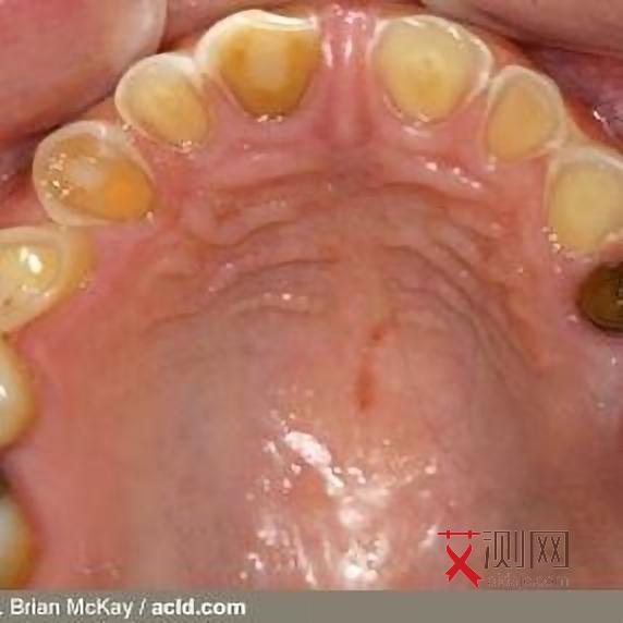 艾滋病初期特征和表现图片