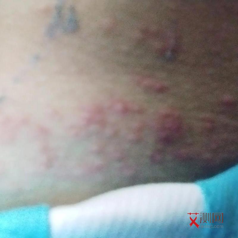 女的得了艾滋病下体会有什么症状图片