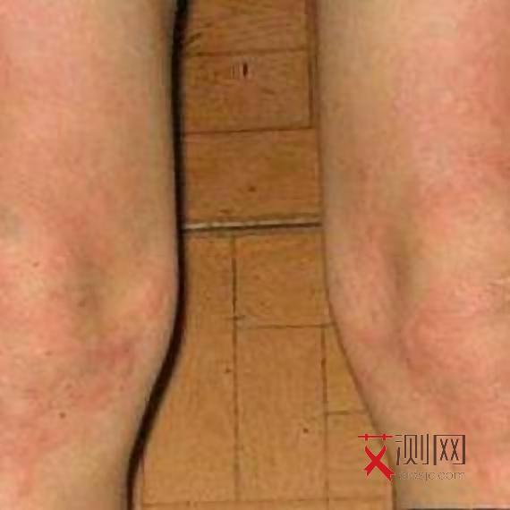 艾滋病多久有感冒症状