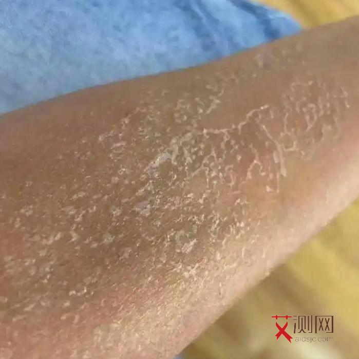 艾滋病身上起红疙瘩吃什么药