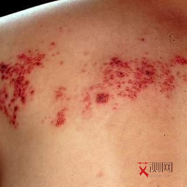 感染艾滋病多久能发现症状和感觉有关