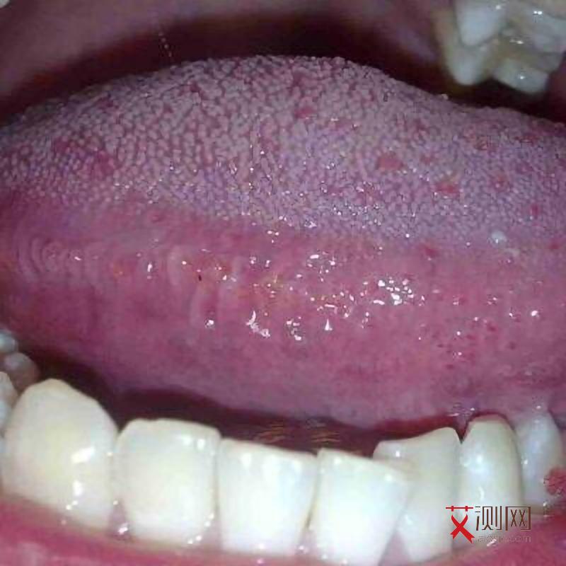 艾滋病的初期症状皮疹有哪些图片女性