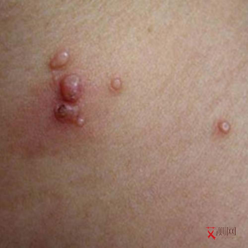 怎么看出男性有没有艾滋病呢图片