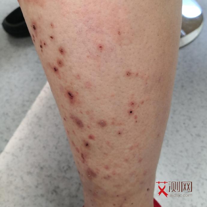 艾滋病的初期症状是什么样的图片和症状