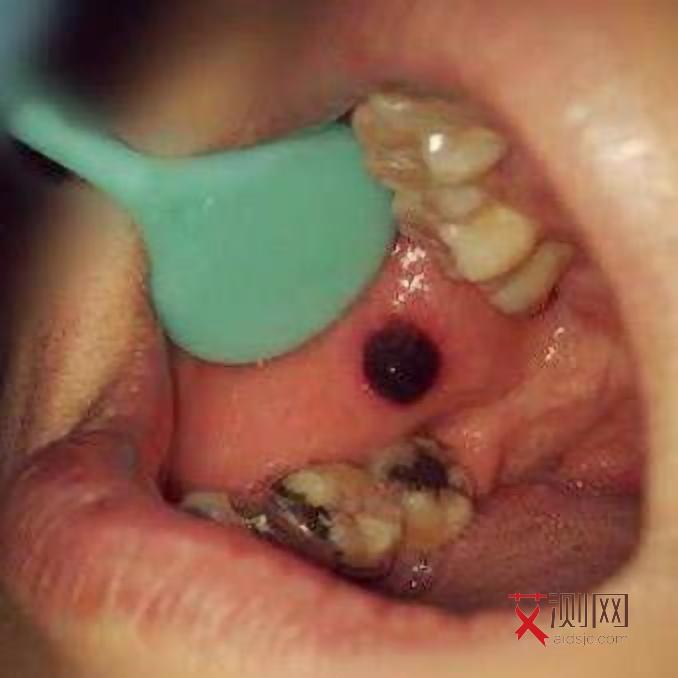 艾滋病多久能检查出抗体阳性和阴性