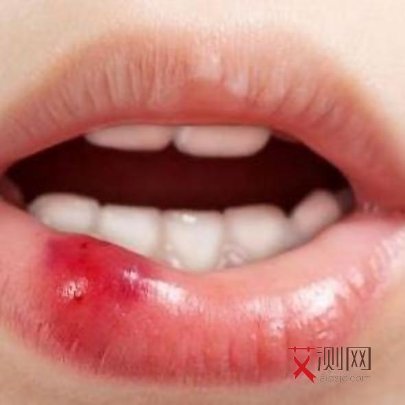 艾滋病有什么症状女性表现吗图片高清图