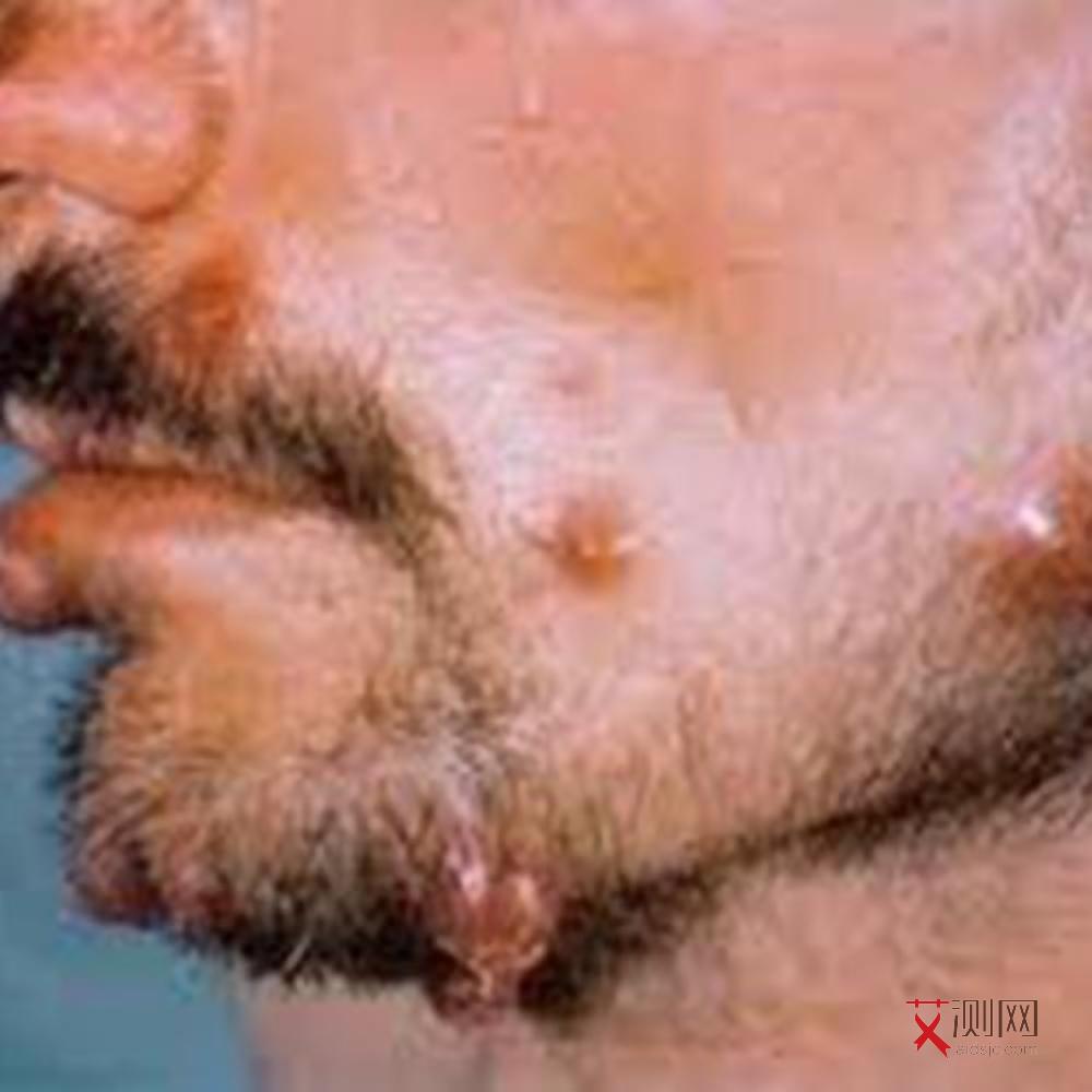 艾滋病病发了还能活多久啊