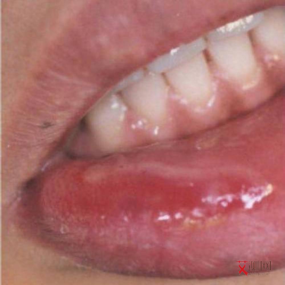 艾滋病肿瘤图片大全真实