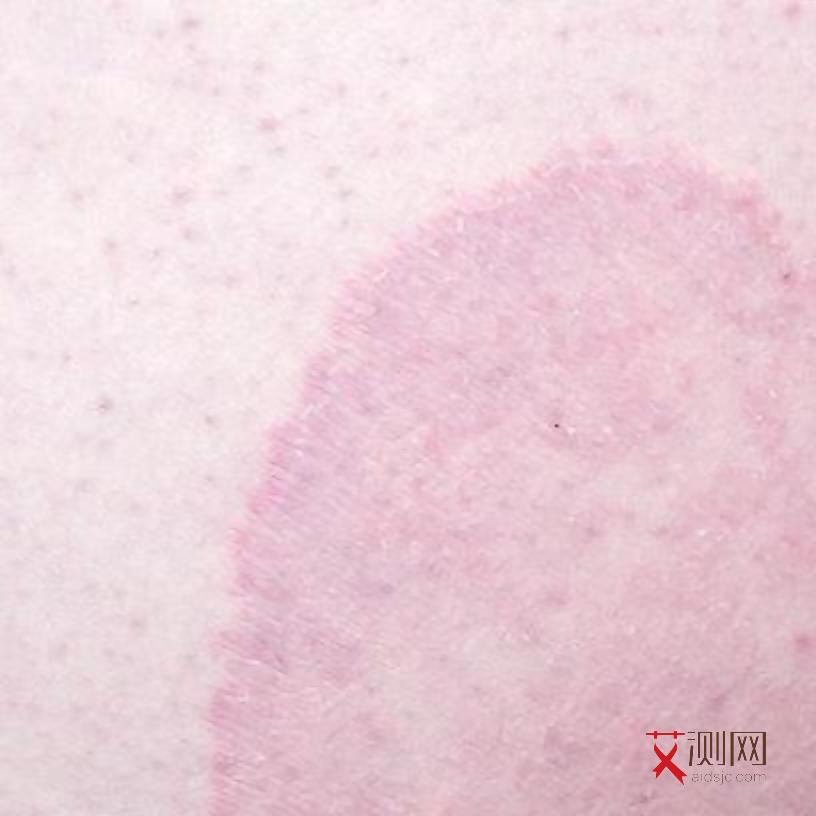 艾滋病初期症状有哪些症状图片女性吃什么药治疗