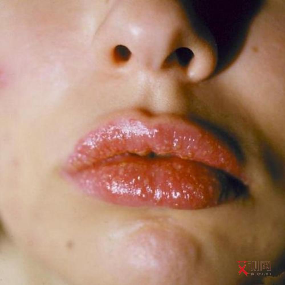 艾滋病男性前兆图片大全高清