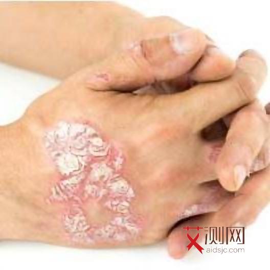 艾滋病初期女性女性生殖器,症状表现有哪些图片