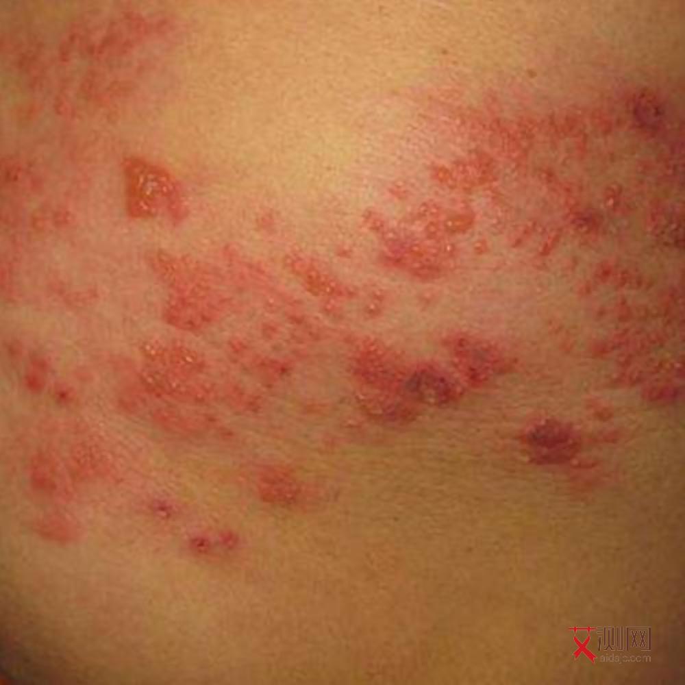 艾滋病导致淋巴结肿大有疼痛感吗怎么治疗好