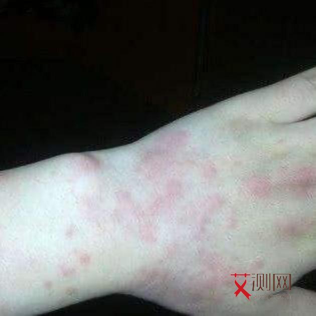 女性感染艾滋病月经反应持续多久会消失