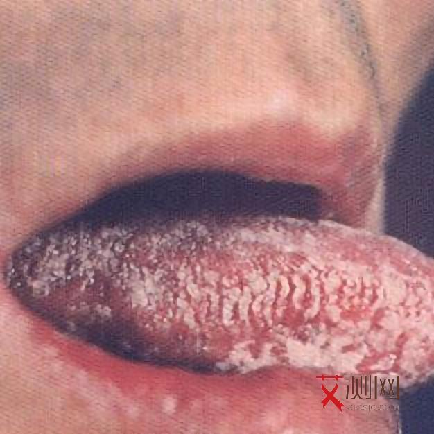 艾滋病前期是什么症状图片女性