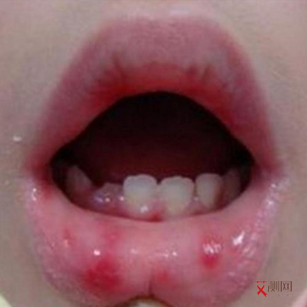 口腔烫伤会感染艾滋吗