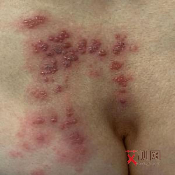 艾滋病的初始表现症状