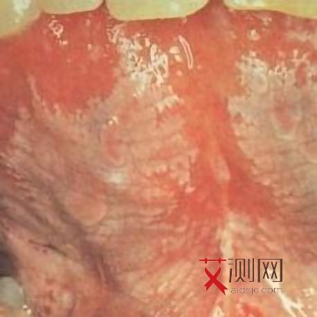 艾滋病临床症状为三个月内体重减轻