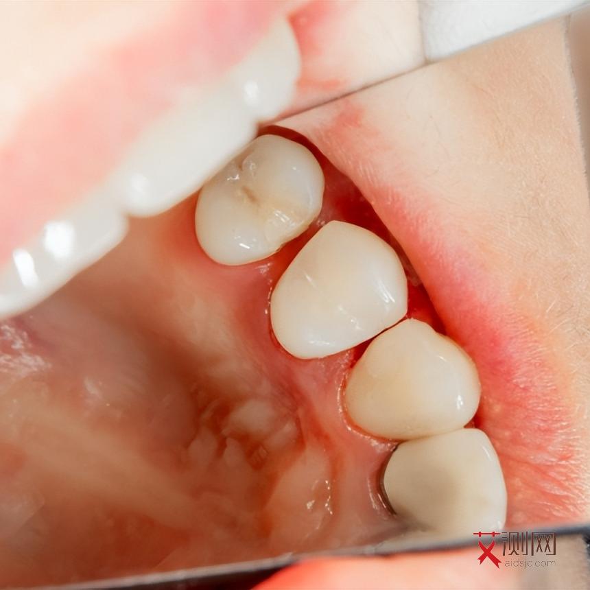 艾滋病患者最明显的症状是哪种症状呢