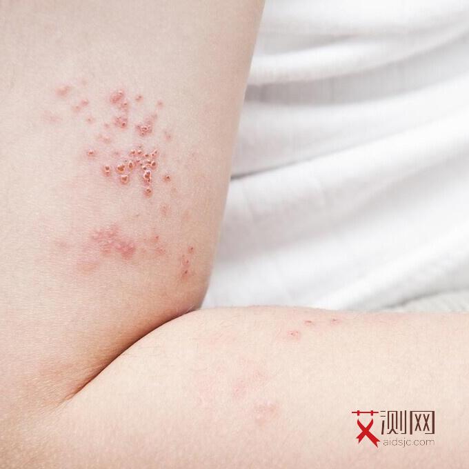 艾滋病男生症状有哪些表现图片