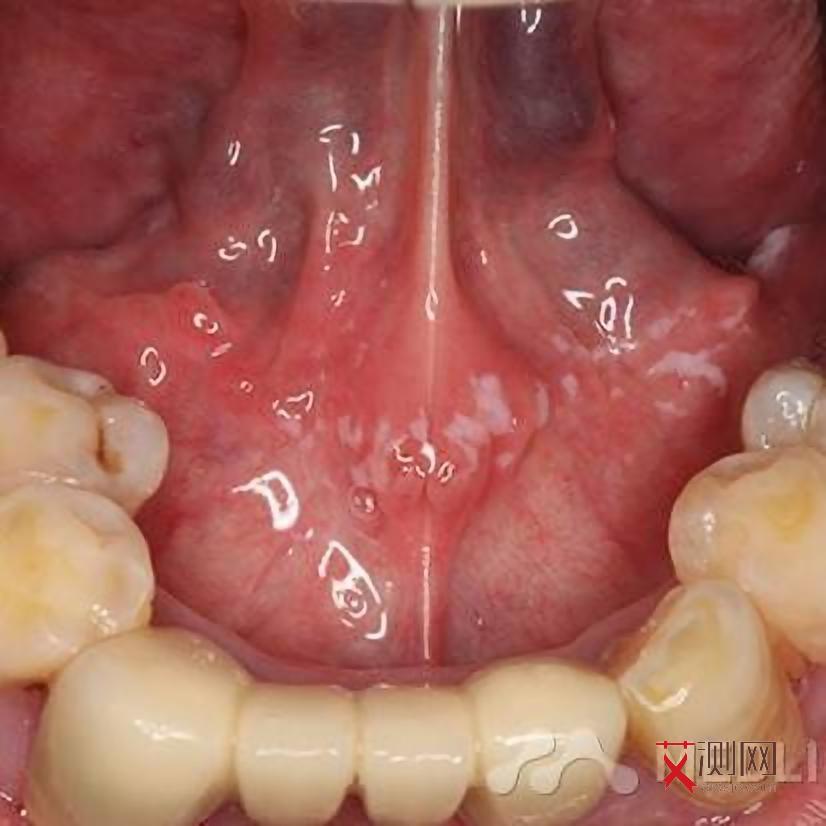 艾滋病女性症状及表现是什么样的