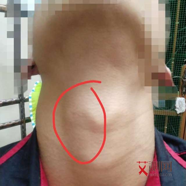 女性感染艾滋病初期下体会有什么症状表现