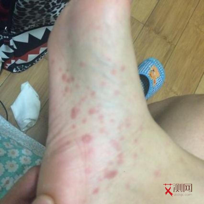 艾滋病明显症状有哪些图片大全图解