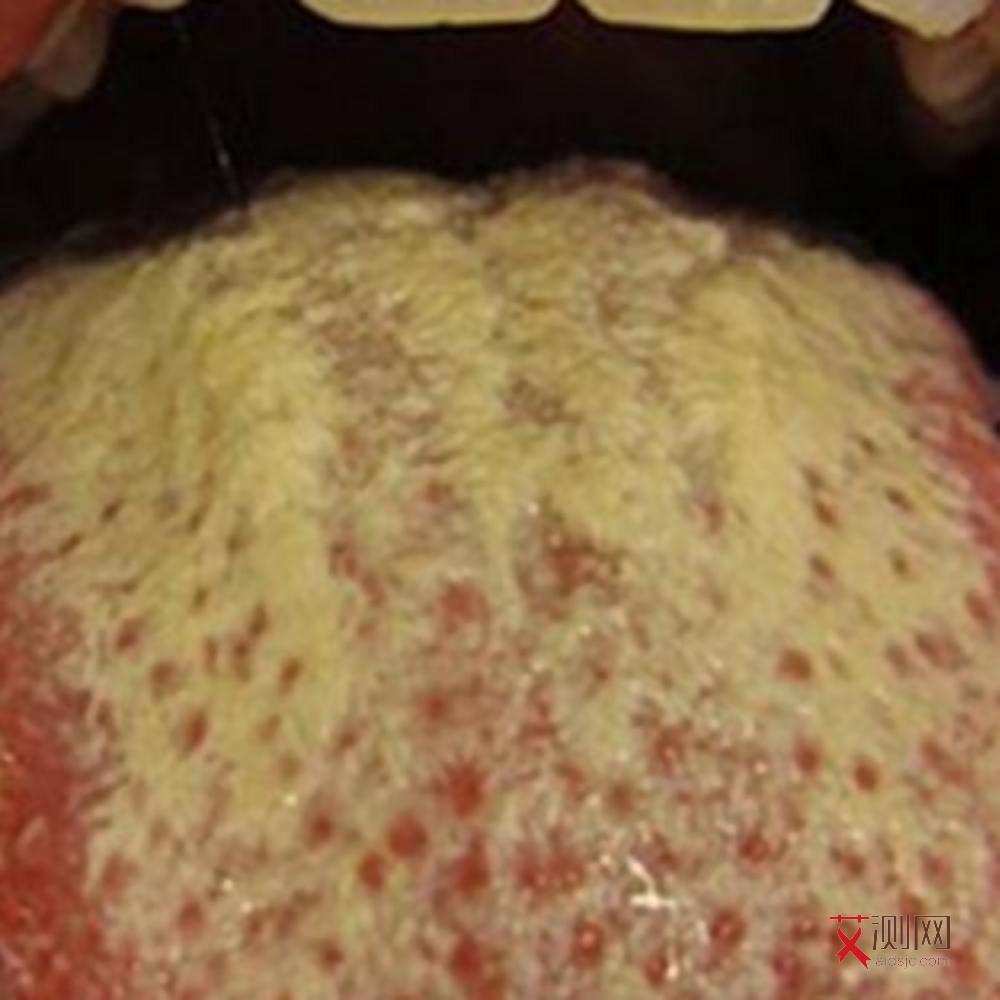 艾滋病患者的口腔可能出现以下哪种症状