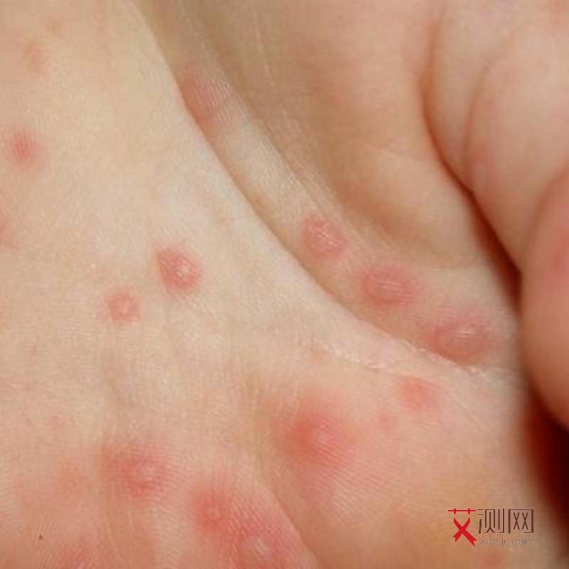 艾滋病身上起红疹吗图片女