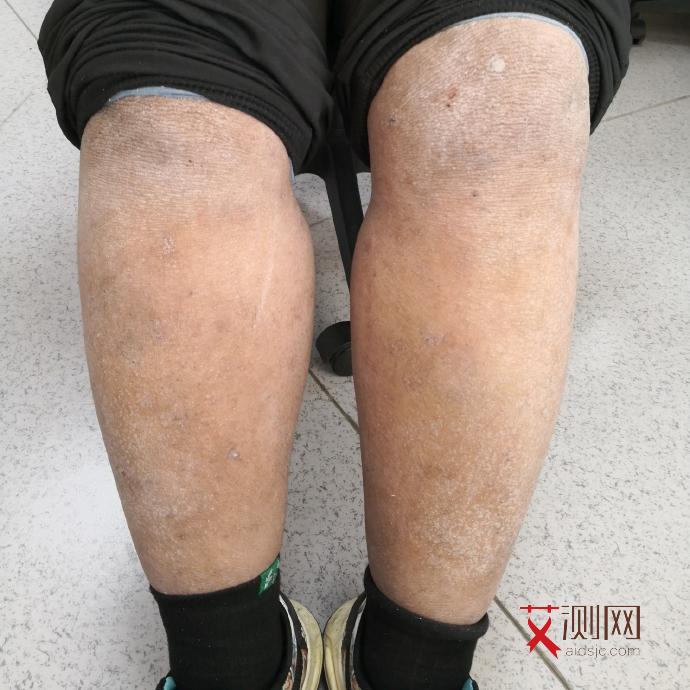 艾滋病皮肤症状会痒吗女人怎么治疗好