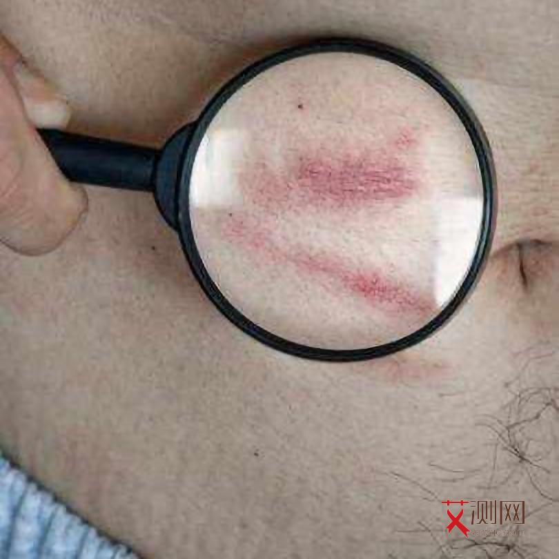 艾滋病皮肤溃烂吗会痒吗图片大全