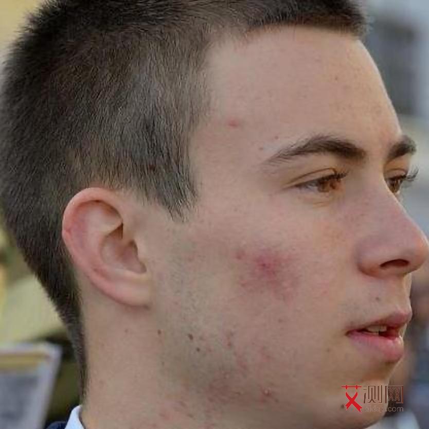 艾滋病会通过口腔溃疡传染吗