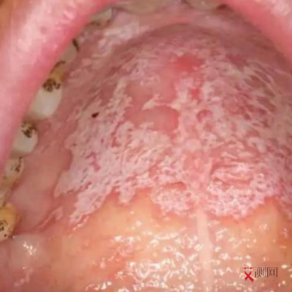 高危后多久试纸才能测出艾滋病呢