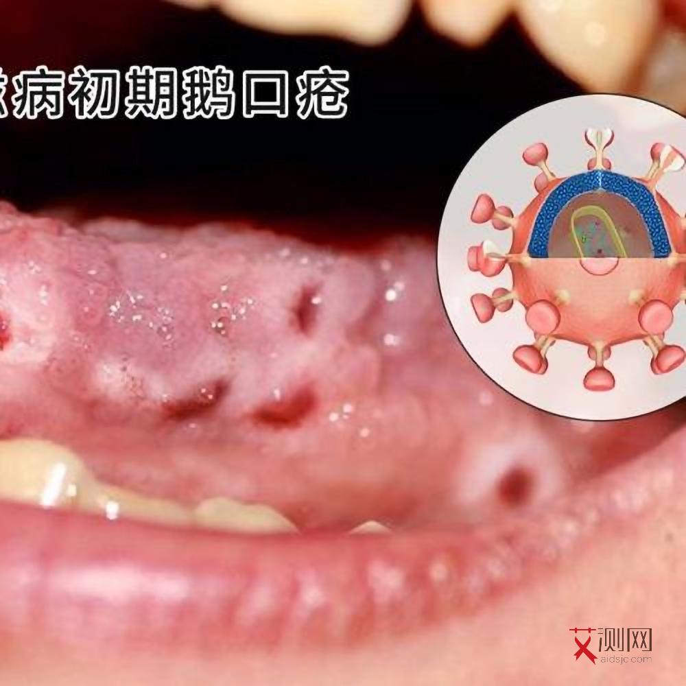 女生艾滋病身上会起什么疹子图片和症状