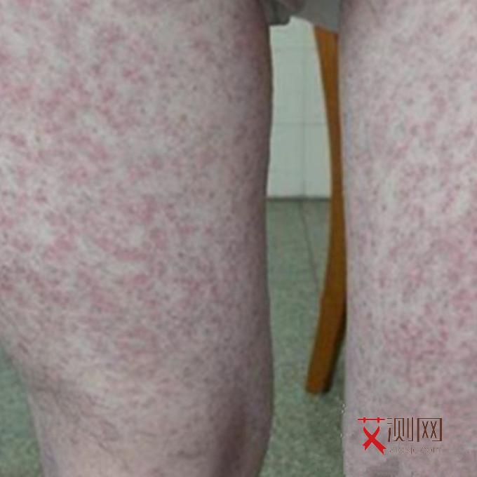 怎么知道自己有没有艾滋病抗体呢