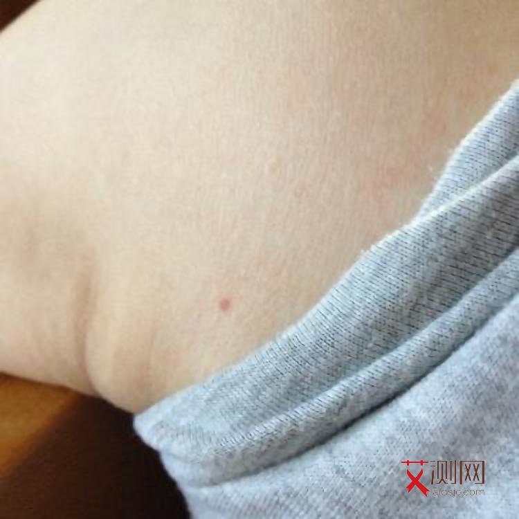 艾滋病晚期有什么症状?