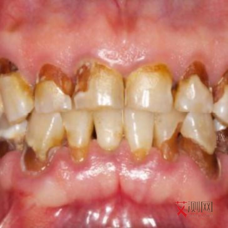 艾滋病多久会出现红斑疹子痒