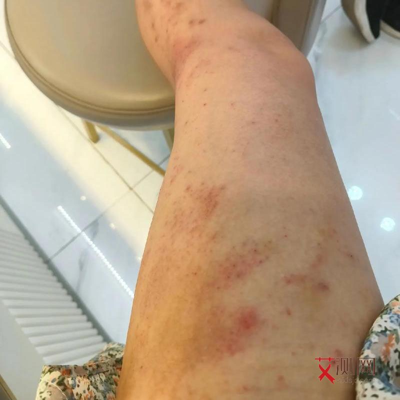 艾滋病生殖器有异味吗