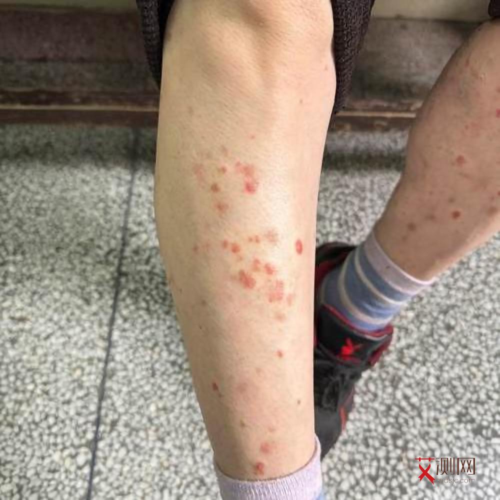 艾滋病症状初期症状皮疹图片大全图解