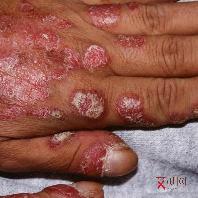 艾滋病身上起红色的包图片