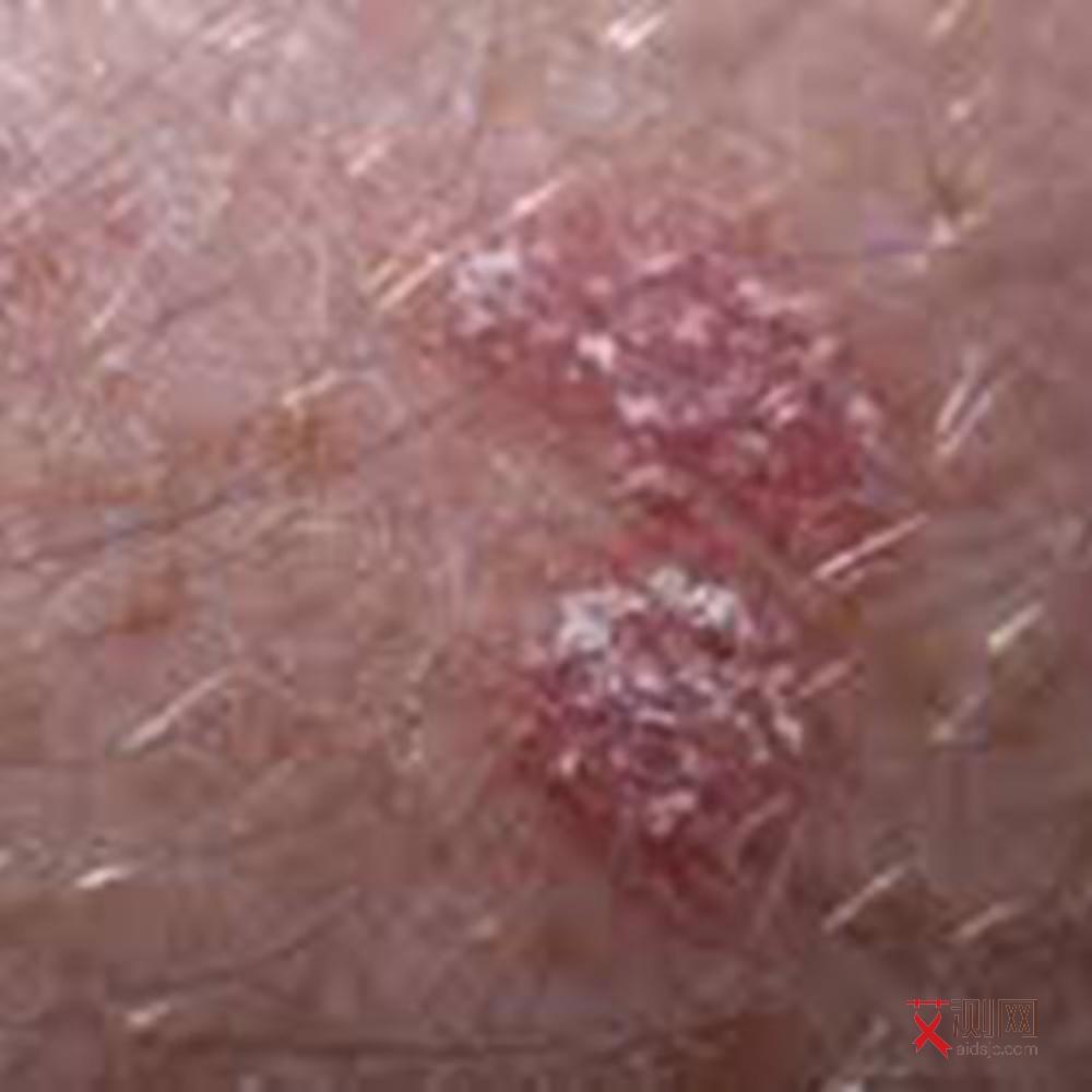 艾滋病感染概率大吗