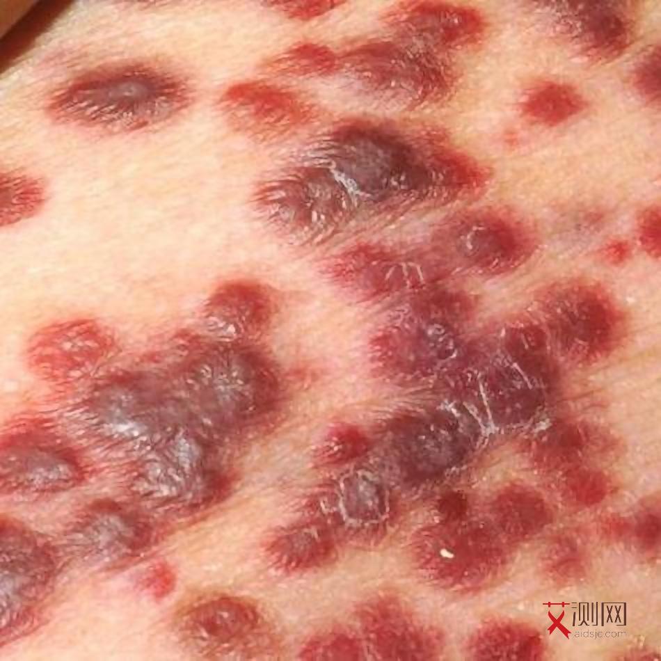 艾滋病人发冷怎么办